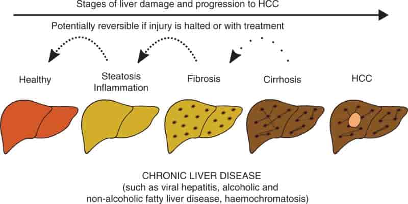 از فیبروز کبدی تا سیروز کبدی