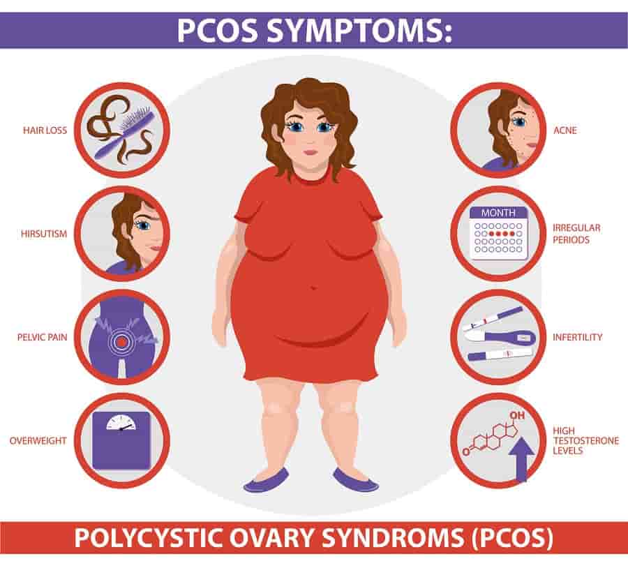علائم و نشانه های سندروم تخمدان پلی کیستیک (PCOS)