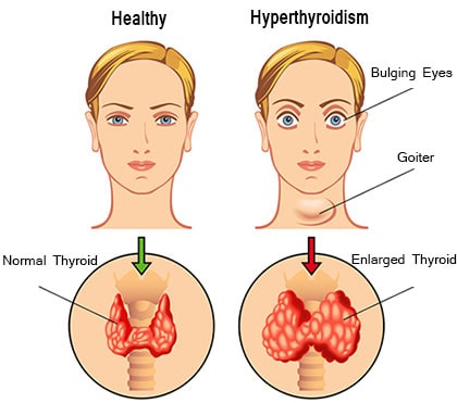 همه چیز درباره بیماری پرکاری تیروئید