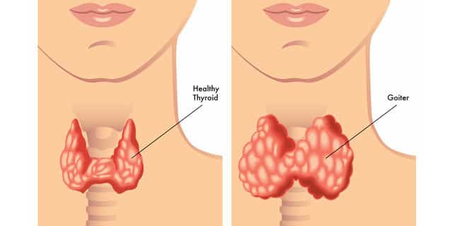 کم کاری تیروئید یا هیپوتیروئید پیست؟