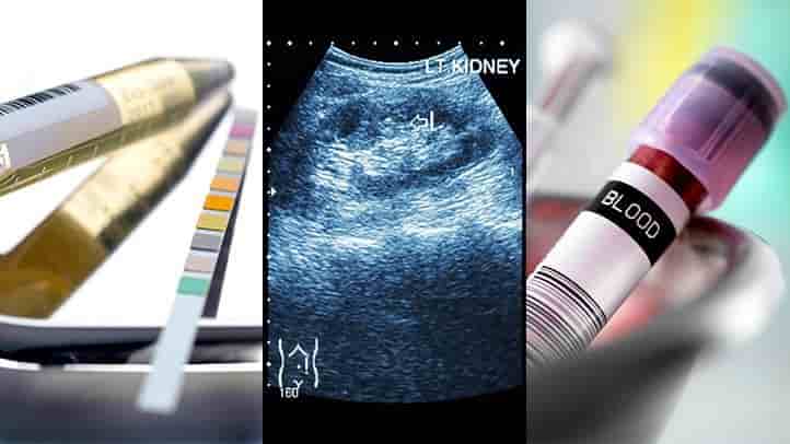 نحوه ی تشخیص سنگ کلیه
