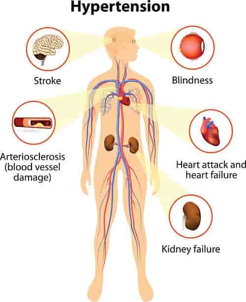 مشکلات فشار خون بالا